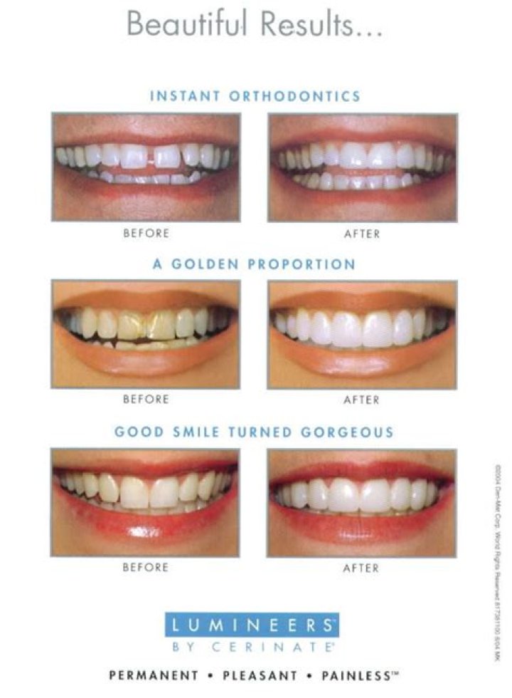 Are Lumineers reversible?