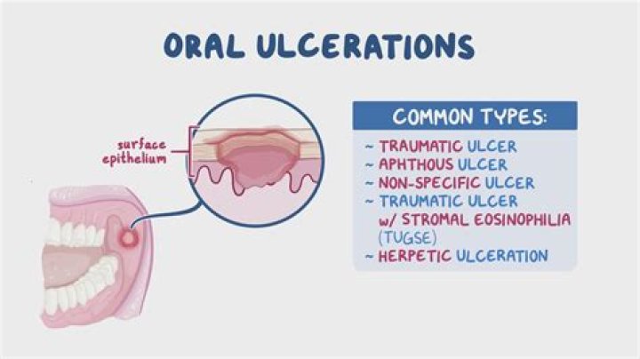 Are ulcers painful?