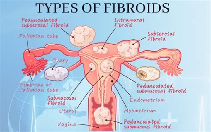Can small fibroids cause pain?
