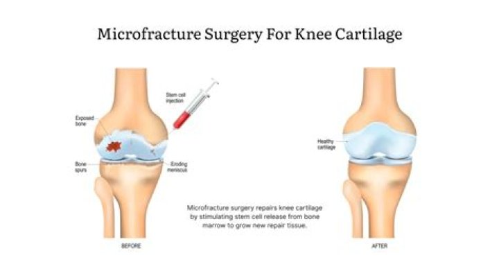 Can the cartilage in your knee grow back?