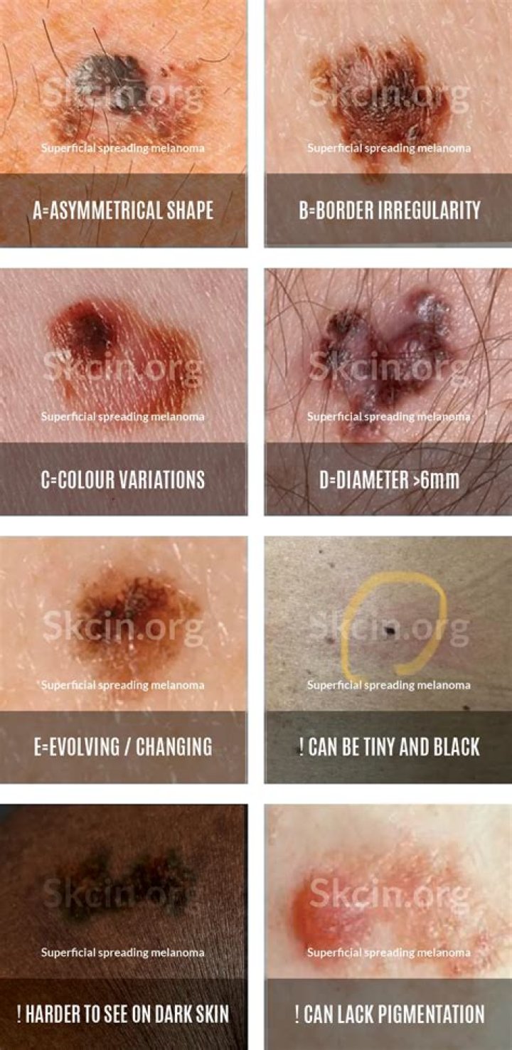 Can you get cancer from picking a mole?