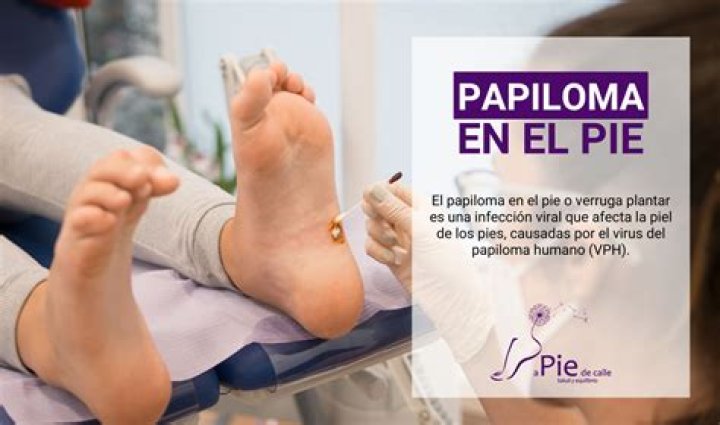 ¿Cómo eliminar el papiloma cutáneo?
