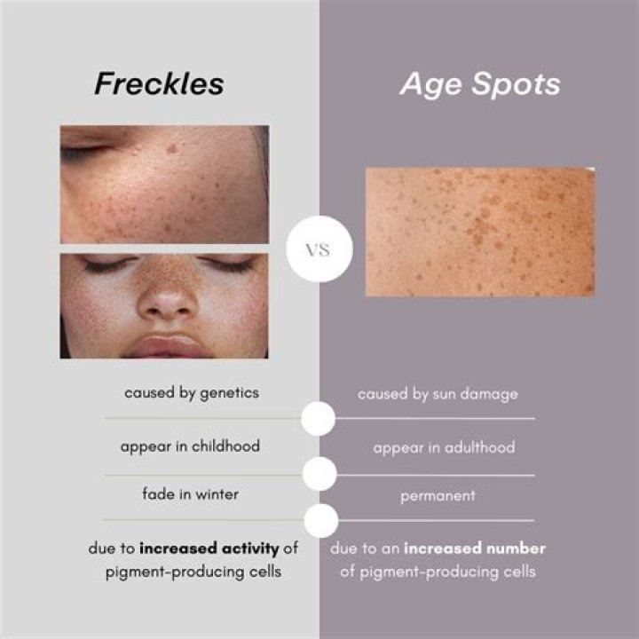 Do freckles fade with age?