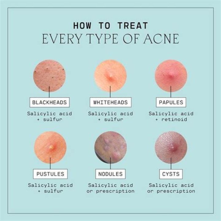 Does acetone get rid of pimples?