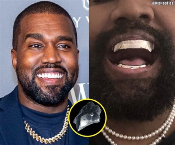 Does Kanye still have diamond teeth?
