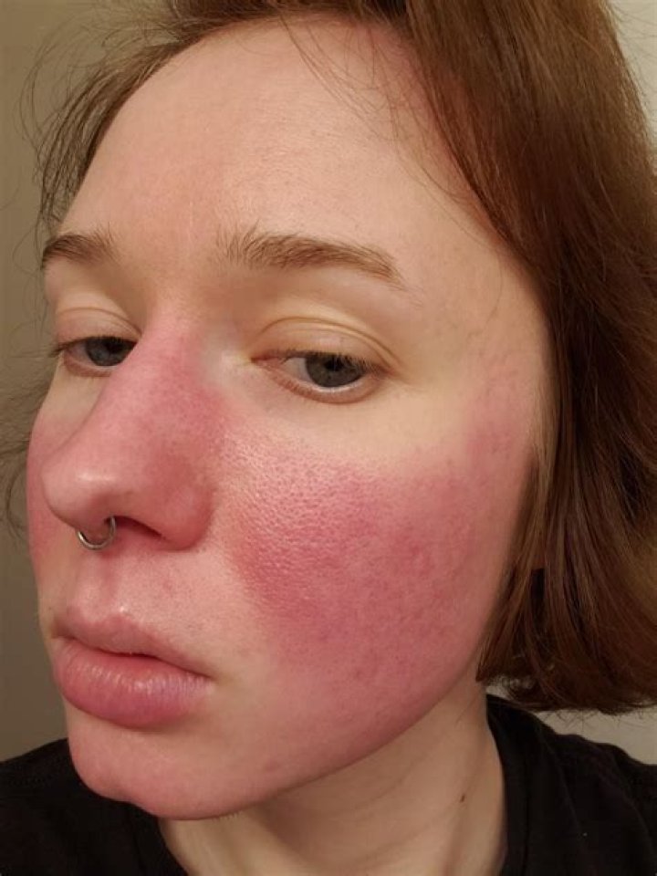 How do you cure a red face?