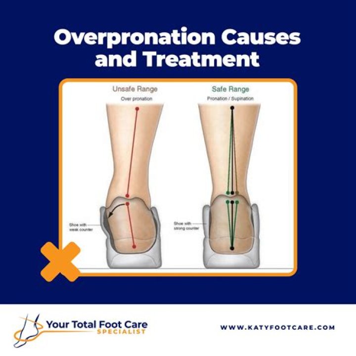 How do you cure pronation?