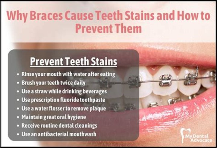 How do you get rid of brown stains on your teeth from braces?