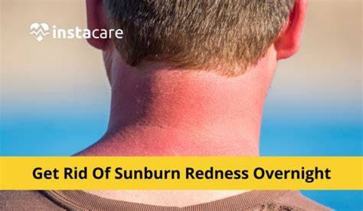 How do you get rid of sun burn marks?