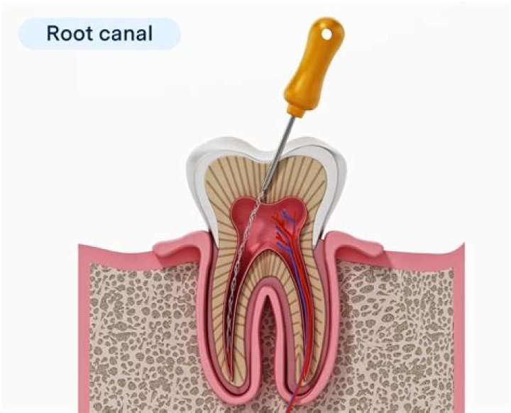 How long is a root canal good for?