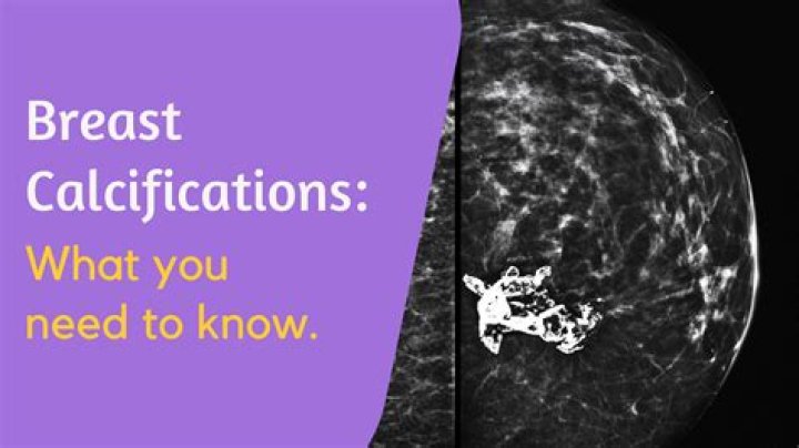 What are the odds of breast calcifications being cancerous?