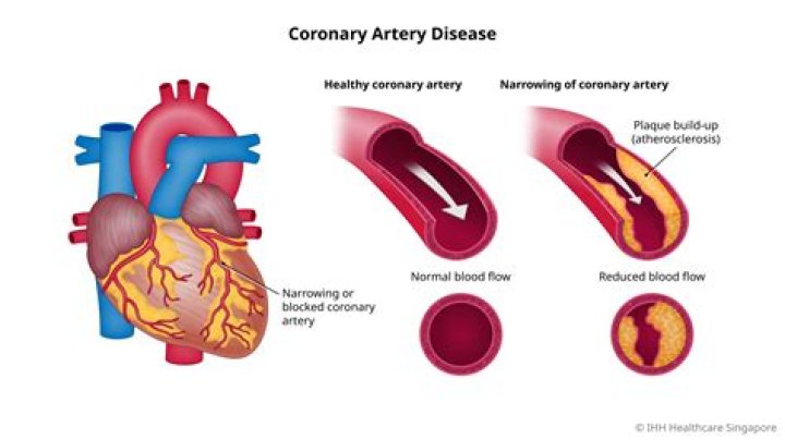 What causes narrowing of blood vessels?