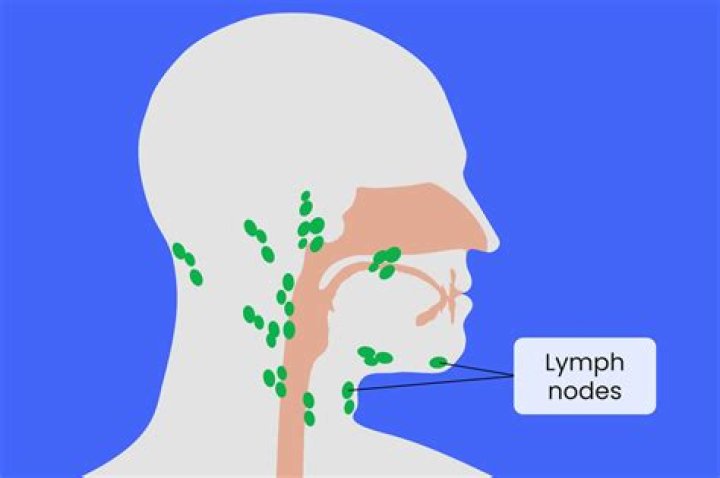 What do swollen lymph nodes indicate?