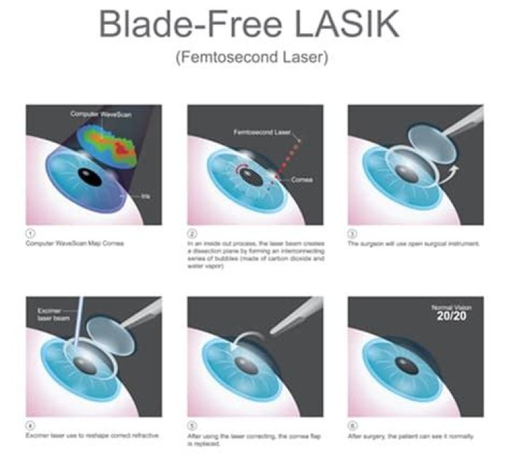 What is Blade Lasik?