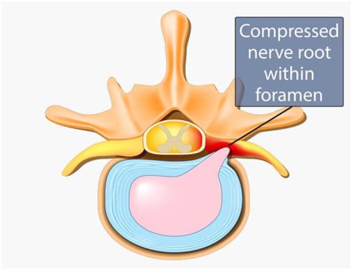 What is neural Foraminal stenosis?