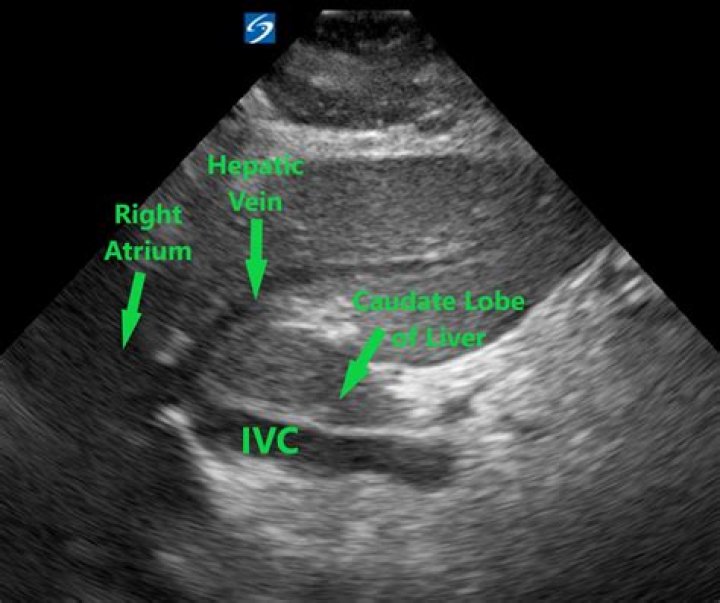 What is side lobe in ultrasound?