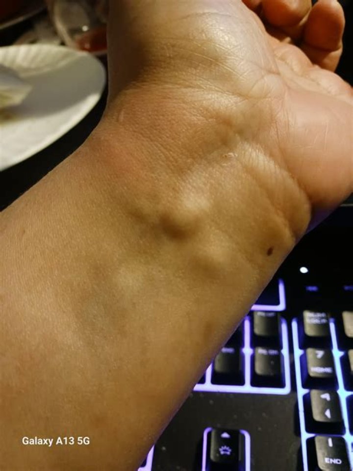 What is this lump on my wrist?