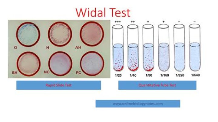 What is widal test negative?