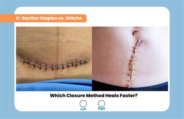 What type of stitches are used for C section?