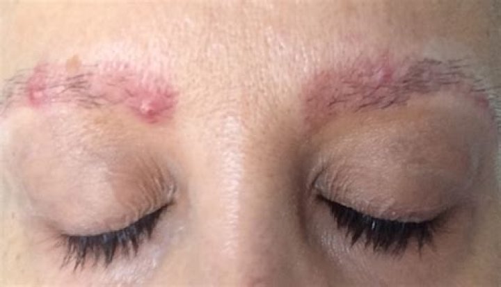 Why am I getting pimples in my eyebrows?