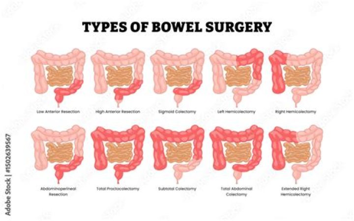 Why are bowel diversions performed?