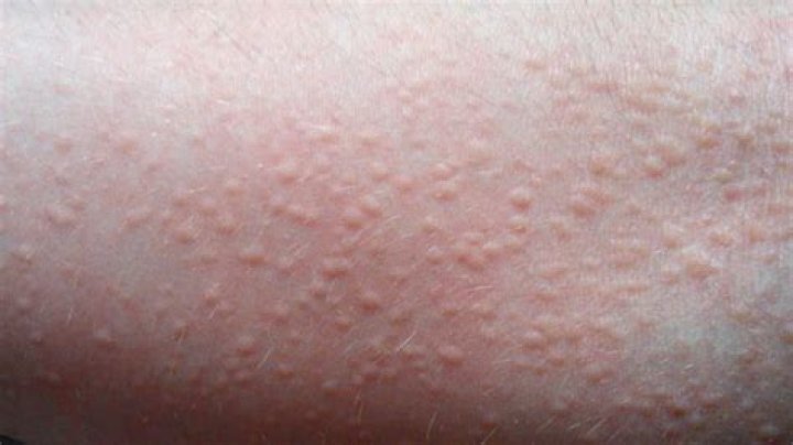 Why do I randomly break out in hives?