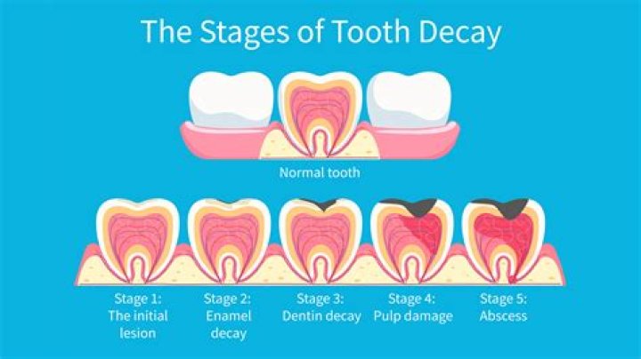 Why is baking soda bad for your teeth?