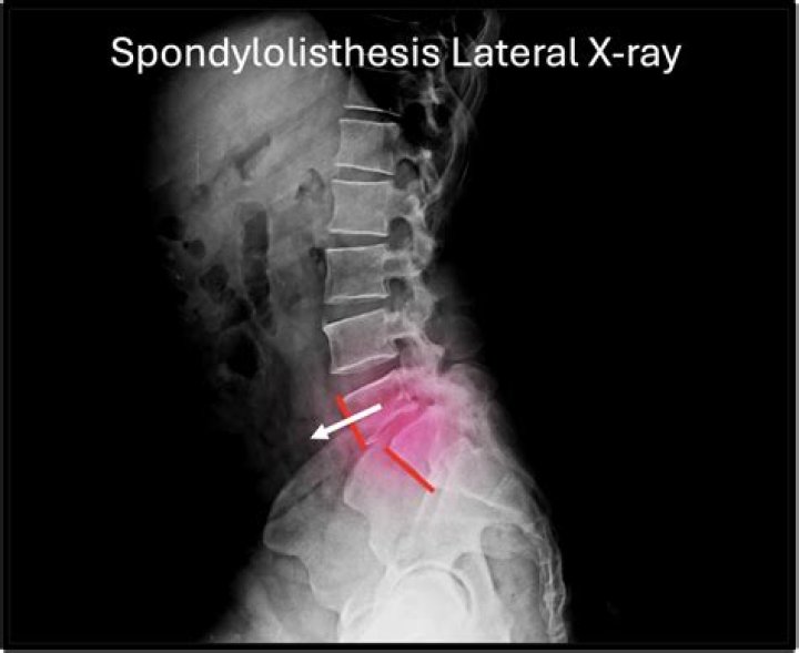 Will an xray show spondylolisthesis?