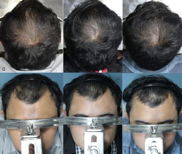 Will hair shed Rogaine grow back?